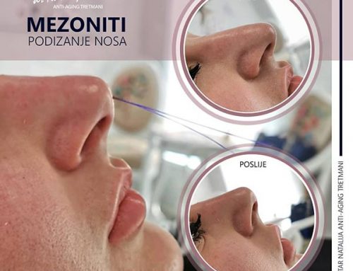 Podizanje nosa MEZONITIMA – Nehirurška korekcija nosa mezonitima