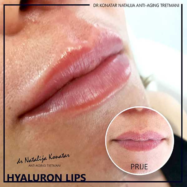 Hyaluron Lips
