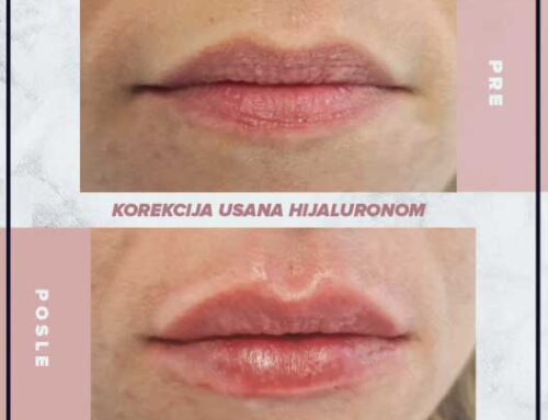 Korekcija usana hijaluronom