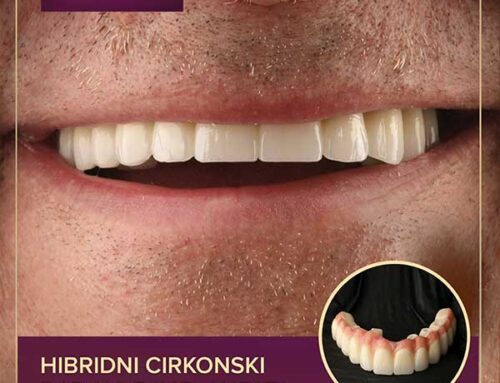 Hibridni cirkonski rad na 5 implantata