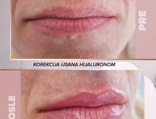 Korekcija usana hijaluronom