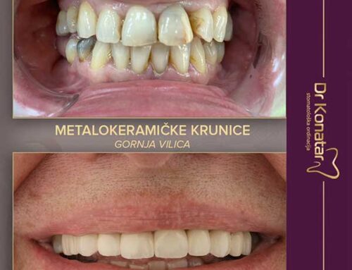 Metalokeramičke krunice