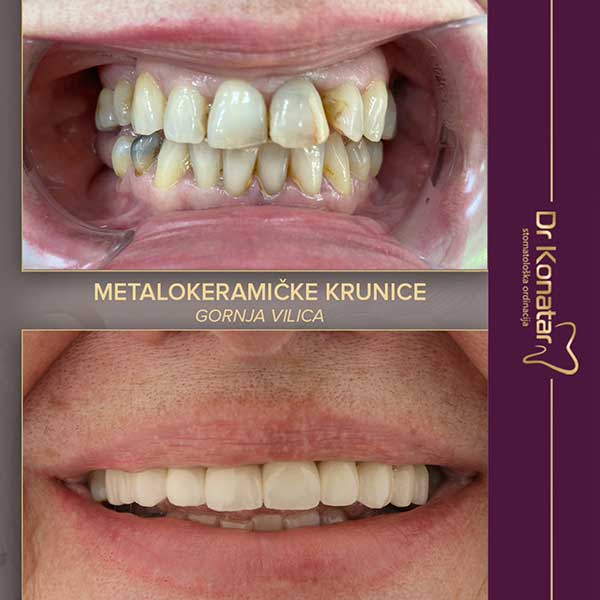 MetalokeramickeKruniceGV