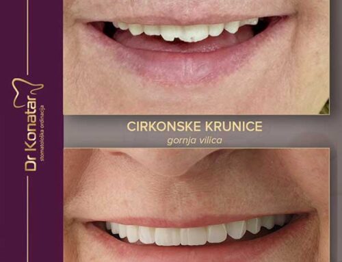 Cirkonske krunice