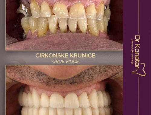 Cirkonske krunice