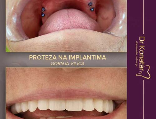 Proteze na implantima