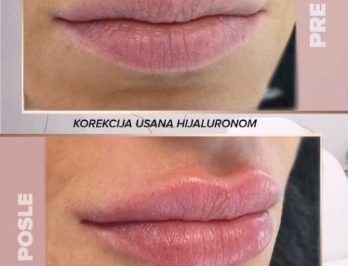 Korekcija usana hijaluronskim filerim