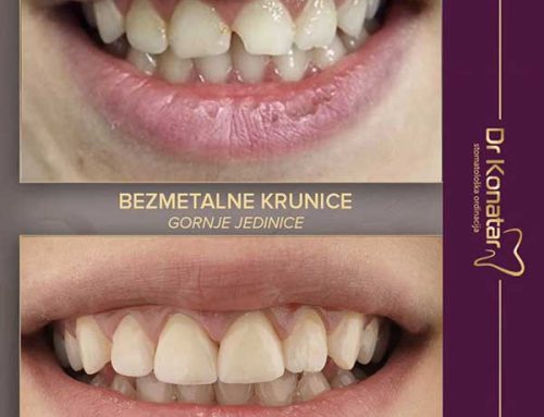 Bezmetalne keramičke krunice