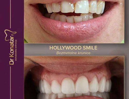 Hollywood Smile