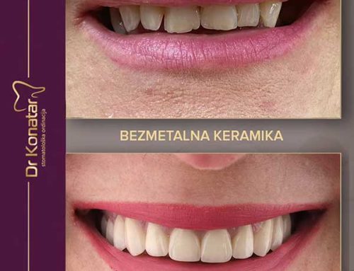 Bezmetalne krunice — za savršen osmijeh