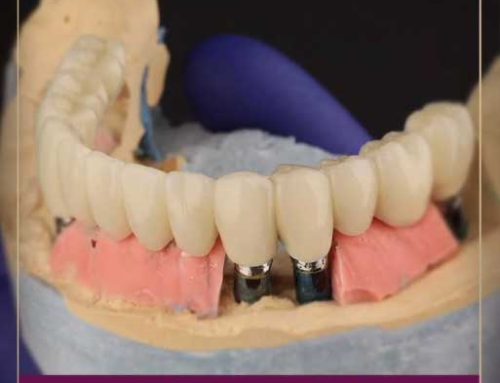 Protetski rad na implantima