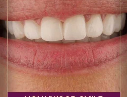 Hollywood Smile