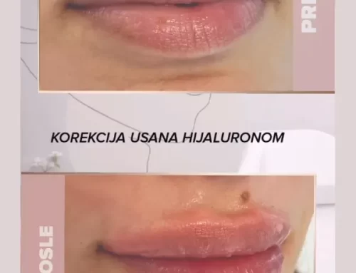 Korekcija usana hijaluronom
