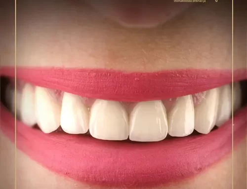 Bezmetalne keramičke krunice