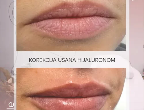 Korekcija usana hijaluronom