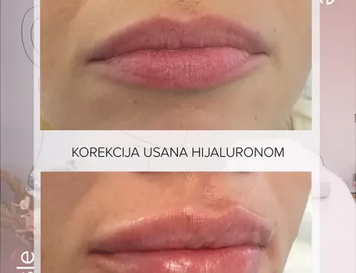 Korekcija usana hijaluronom