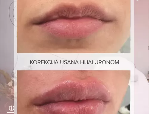 Korekcija usana hijaluronom