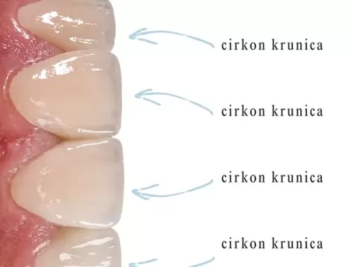 Cirkonske krunice