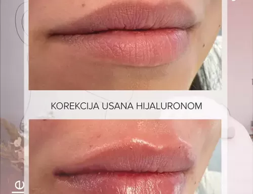 Korekcija usana hijaluronom