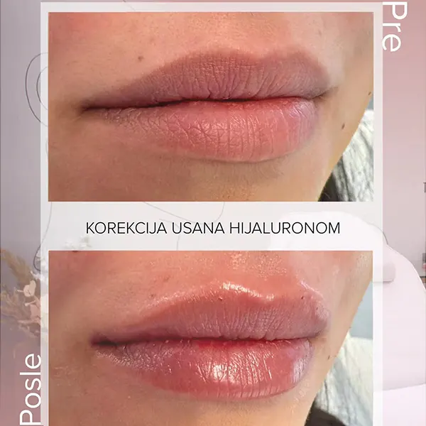 usneHijaluron2