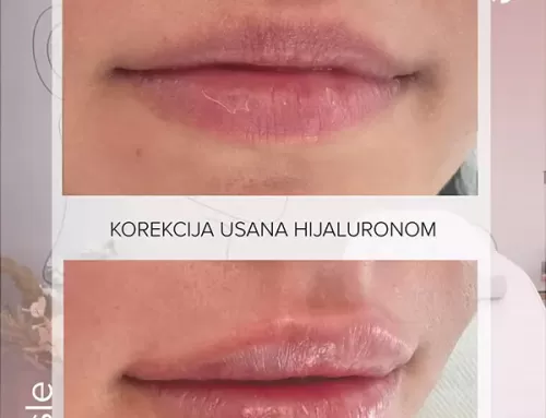 Korekcija usana hijaluronom