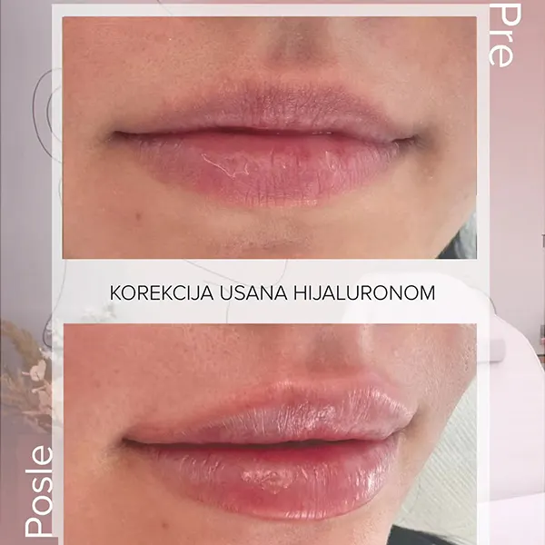 PrePosle1