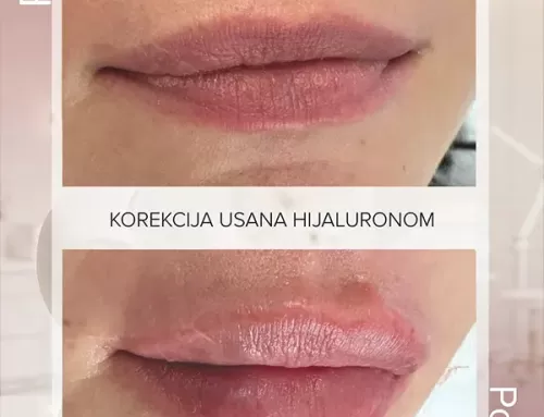 Korekcija usana hijaluronom