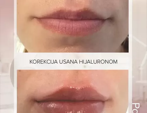 Korekcija usana hijaluronom